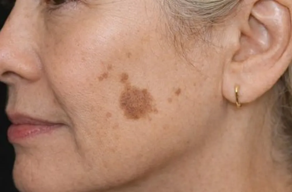 bpc 157 acne Peptide therapy can sound overwhelming TB-500, BPC-157, NAD+, MOTS-c what does it all mean?! Here's the truth: you don't have to figure it out alone. Each peptide has a purpose BPC-157+GHK-Cu Recovery Cream Body