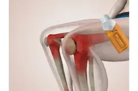 Experts Stunned: Easy Solution for Years of Joint Pain and Arthritis